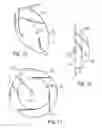 Fig. 08 - Mapping retinal function using corneal electrode array
