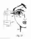 Fig. 10 - Mapping retinal function using corneal electrode array