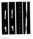 Fig. 01 - Precision subtraction computed tomographic angiography