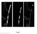 Fig. 07 - Precision subtraction computed tomographic angiography