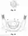 Fig. 18 - Dental prosthetic
