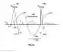 Fig. 27 - Method of timing pulsatile flow of normothermic perfusate to the heart