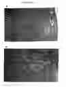 Fig. 25 - Methods for treatment or prophylaxis of aldosterone-mediated pathogenic effects in a subject using an epoxy-steroidal aldosterone antagonist