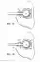Fig. 08 - Tissue irradiation with shielding