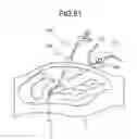 Fig. 37 - Intra-subject medical system, method of operating body-insertable apparatus and operative treatment