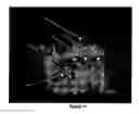 Fig. 12 - Actinic light colposcope and method to detect lesions in the lower female genital tract produced by human papilloma virus using an actinic light colposcope