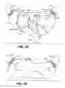 Fig. 03 - Surgical system and procedure for treatment of medically refractory atrial fibrillation