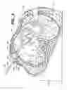 Fig. 08 - Surgical system and procedure for treatment of medically refractory atrial fibrillation