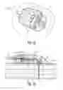 Fig. 11 - Low profile infusion set