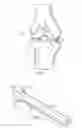 Fig. 02 - Osteochondral implant fixation method
