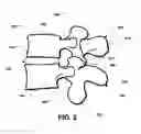 Fig. 03 - Intervertebral prosthetic disc inserter