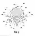 Fig. 04 - Intervertebral prosthetic disc inserter