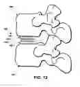 Fig. 10 - Intervertebral prosthetic disc inserter