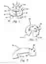 Fig. 02 - Instruments and methods for implanting nucleus replacement material in an intervertebral disc nucleus space
