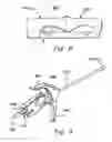 Fig. 06 - Instruments and methods for implanting nucleus replacement material in an intervertebral disc nucleus space