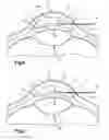 Fig. 03 - Method and apparatus for forming an aperture in a lens capsule of an eye