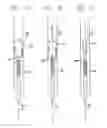 Fig. 02 - FILTER/EMBOLI EXTRACTOR FOR USE IN VARIABLE SIZED BLOOD VESSELS