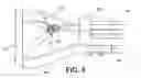 Fig. 04 - LINEAR LIGATION BAND