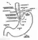 Fig. 01 - Transesophageal gastric reduction method and device for practicing same