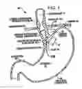 Fig. 02 - Transesophageal gastric reduction method and device for practicing same