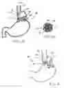 Fig. 04 - Transesophageal gastric reduction method and device for practicing same