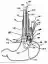 Fig. 01 - Transesophageal gastric reduction method and device for reducing the size of a previously formed gastric reduction pouch