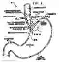 Fig. 02 - Transesophageal gastric reduction method and device for reducing the size of a previously formed gastric reduction pouch