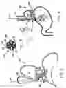 Fig. 03 - Transesophageal gastric reduction method and device for reducing the size of a previously formed gastric reduction pouch