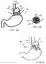 Fig. 04 - Transesophageal gastric reduction method and device for reducing the size of a previously formed gastric reduction pouch