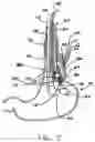 Fig. 05 - Transesophageal gastric reduction method and device for reducing the size of a previously formed gastric reduction pouch