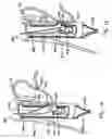 Fig. 09 - Transesophageal gastric reduction method and device for reducing the size of a previously formed gastric reduction pouch