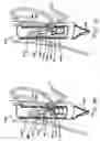 Fig. 11 - Transesophageal gastric reduction method and device for reducing the size of a previously formed gastric reduction pouch