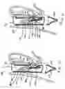 Fig. 12 - Transesophageal gastric reduction method and device for reducing the size of a previously formed gastric reduction pouch