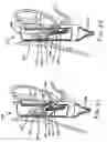 Fig. 13 - Transesophageal gastric reduction method and device for reducing the size of a previously formed gastric reduction pouch