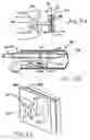 Fig. 14 - Transesophageal gastric reduction method and device for reducing the size of a previously formed gastric reduction pouch