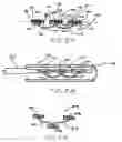 Fig. 15 - Transesophageal gastric reduction method and device for reducing the size of a previously formed gastric reduction pouch