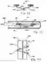 Fig. 17 - Transesophageal gastric reduction method and device for reducing the size of a previously formed gastric reduction pouch