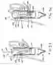 Fig. 18 - Transesophageal gastric reduction method and device for reducing the size of a previously formed gastric reduction pouch