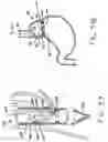 Fig. 19 - Transesophageal gastric reduction method and device for reducing the size of a previously formed gastric reduction pouch