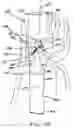 Fig. 23 - Transesophageal gastric reduction method and device for reducing the size of a previously formed gastric reduction pouch