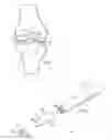 Fig. 02 - Chisel system for osteochondral implants and a surgical procedure involving same