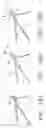 Fig. 15 - Retrievable blood clot filter and method of retrieving