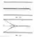Fig. 16 - Retrievable blood clot filter and method of retrieving
