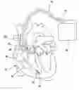 Fig. 01 - Atrial defibrillator