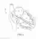 Fig. 02 - Fusion pacing enhancements