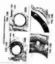 Fig. 18 - MEDICAL DEVICE WITH COATING FOR CAPTURING GENETICALLY-ALTERED CELLS AND METHODS FOR USING SAME