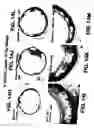 Fig. 20 - MEDICAL DEVICE WITH COATING FOR CAPTURING GENETICALLY-ALTERED CELLS AND METHODS FOR USING SAME