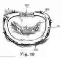 Fig. 10 - Flexible annuloplasty prosthesis