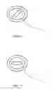 Fig. 10 - Radially extended support member for spinal nucleus implants and methods of use