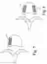 Fig. 06 - Devices and methods for inter-vertebral orthopedic device placement